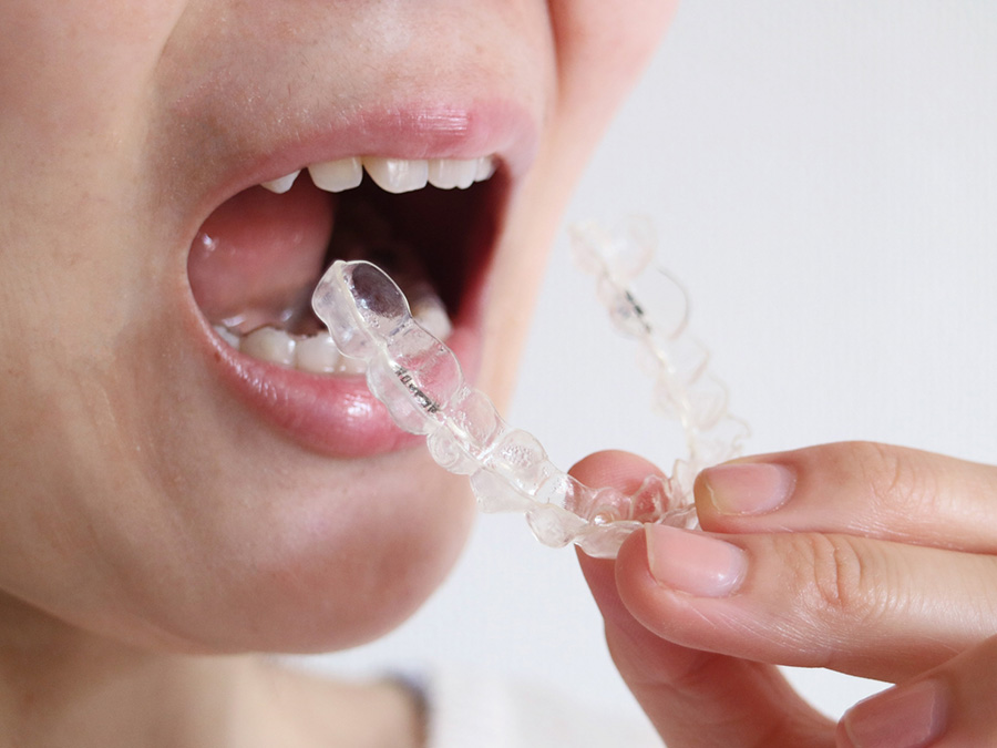 スポーツマウスピース