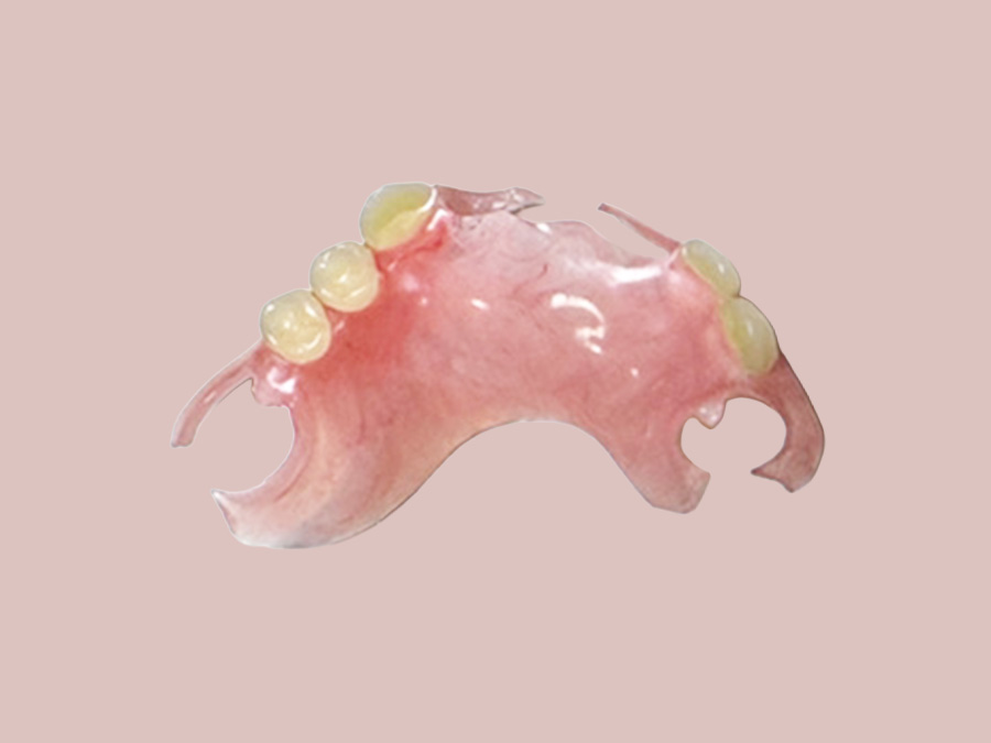 ノンクラスプデンチャー